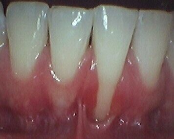 Gum Grafting Pre-op