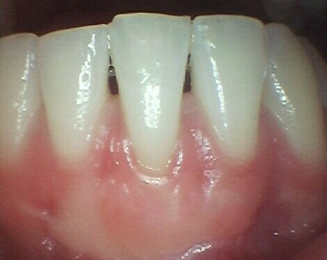 Gum Grafting Post-op 