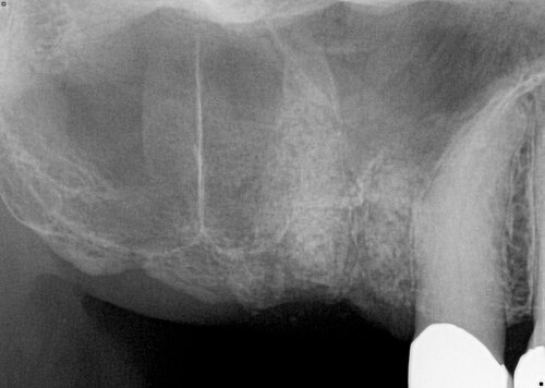 Sinus Bone Augmentation before