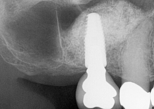 Sinus Bone Augmentation after
