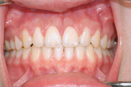 Teeth crown lengthening procedure