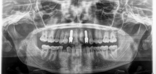 dental implants in the upper jaw