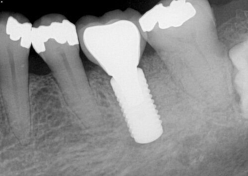 tooth with a dental implant