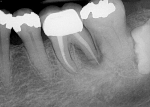 tooth with visible root canal filling