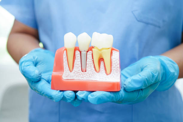 dental implants