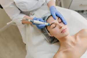 Smoothlase treatment